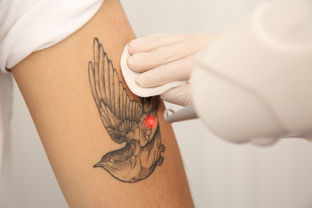 laser bird tattoo removal on arm - U R Royalty Med Spa - Cypress, Texas